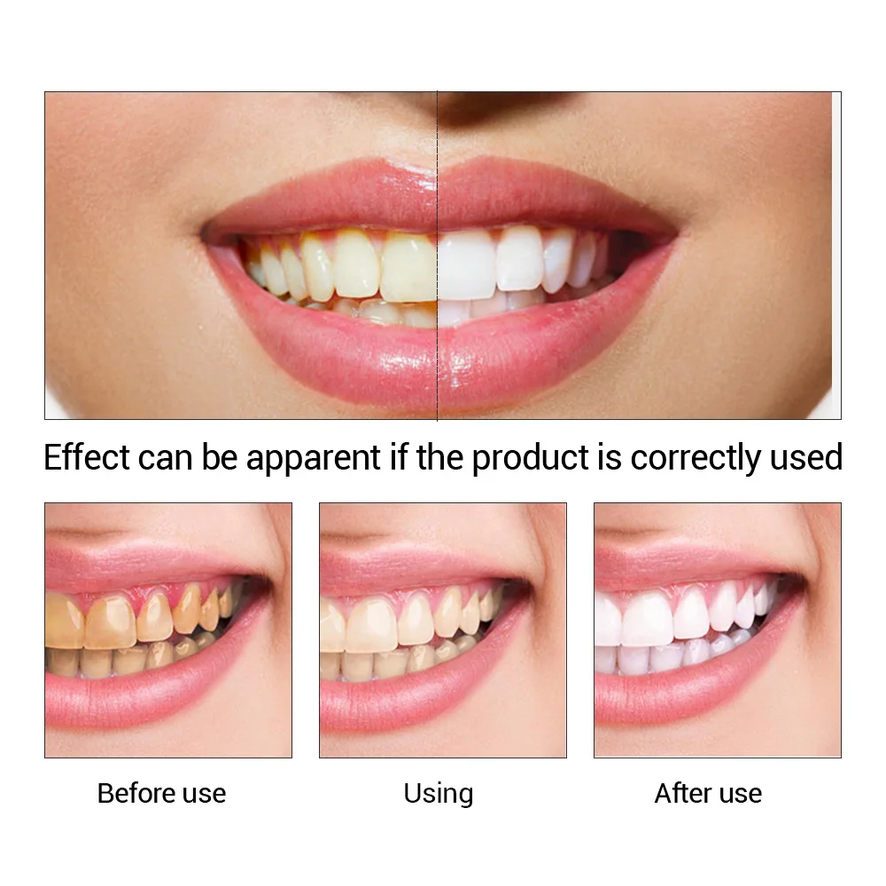 FTEENPLY Làm Trắng Răng Tinh C - đánh giá và giá Teeth Whitening Street