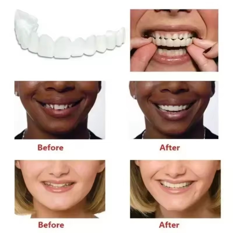 Teeth Veneers Whitening Dentur - đánh giá và giá Teeth Whitening With Braces