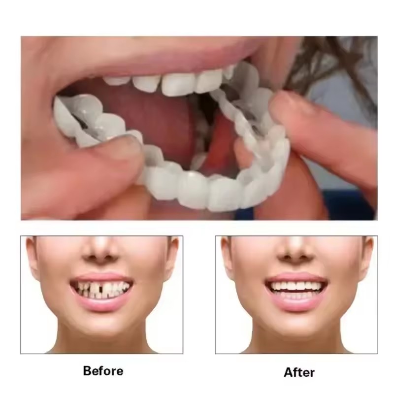 Teeth Veneers Whitening Dentur - đánh giá và giá Teeth Whitening With Braces