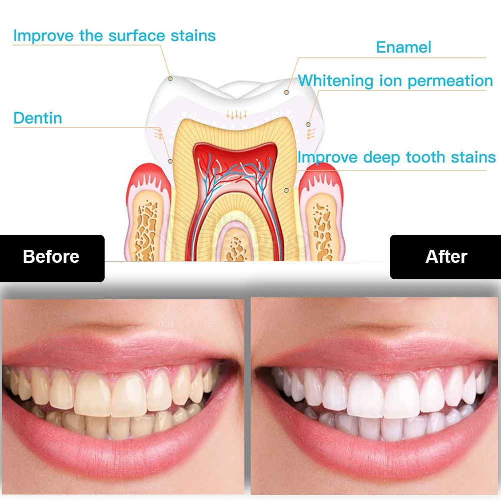 Dental Teeth Whitening Kit Min - đánh giá và giá Teeth Whitening Device